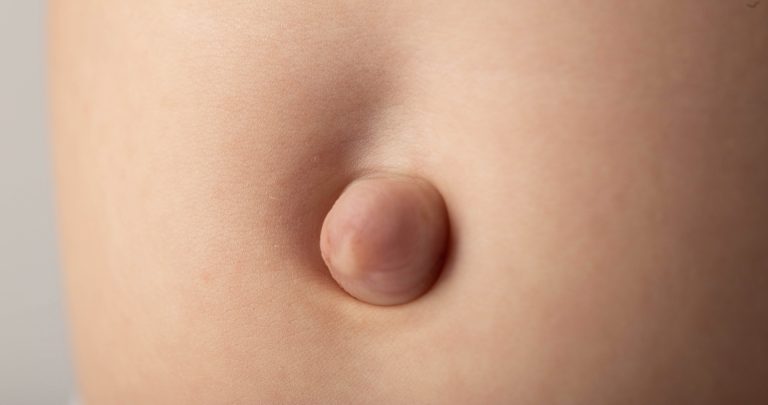 فتق ناف در نوزادان و کودکان: راهنمای کامل برای والدین